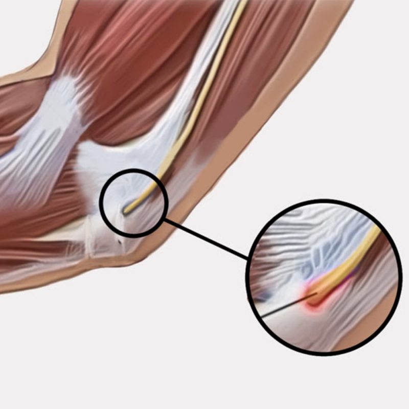 narthikas-olenias-neyritidas-5