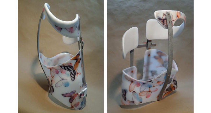 skoliosi-DB1-1-e1541014603394